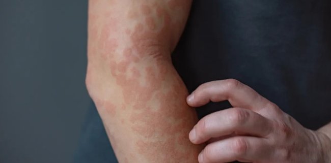 Этот белок называют «тормозом» при кожных воспалениях. Но что это нам дает? - Наука.